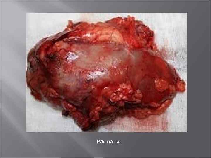 Рак почки 