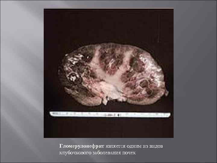 Гломерулонефрит является одним из видов клубочкового заболевания почек 