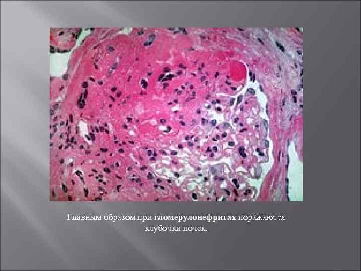 Главным образом при гломерулонефритах поражаются клубочки почек. 