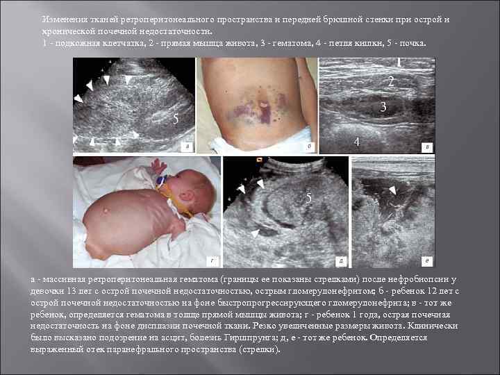 Изменения тканей ретроперитонеального пространства и передней брюшной стенки при острой и хронической почечной недостаточности.