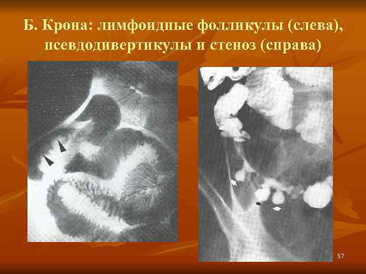 Б. Крона: лимфоидные фолликулы (слева), псевдодивертикулы и стеноз (справа) 37 