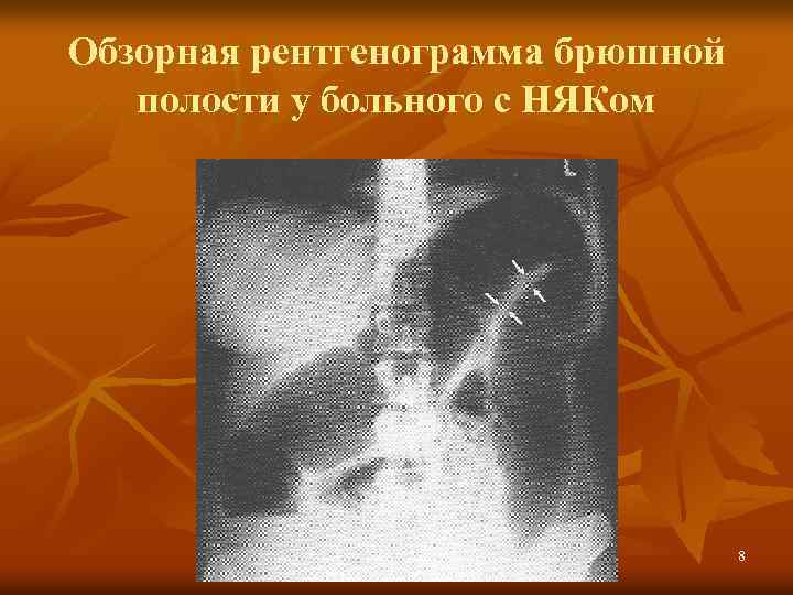 Обзорная рентгенограмма брюшной полости у больного с НЯКом 8 