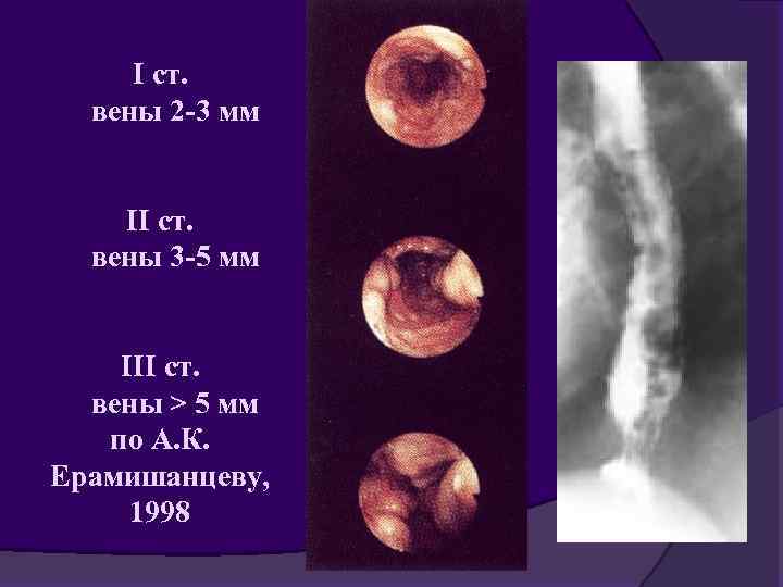 I ст. вены 2 -3 мм II ст. вены 3 -5 мм III ст.