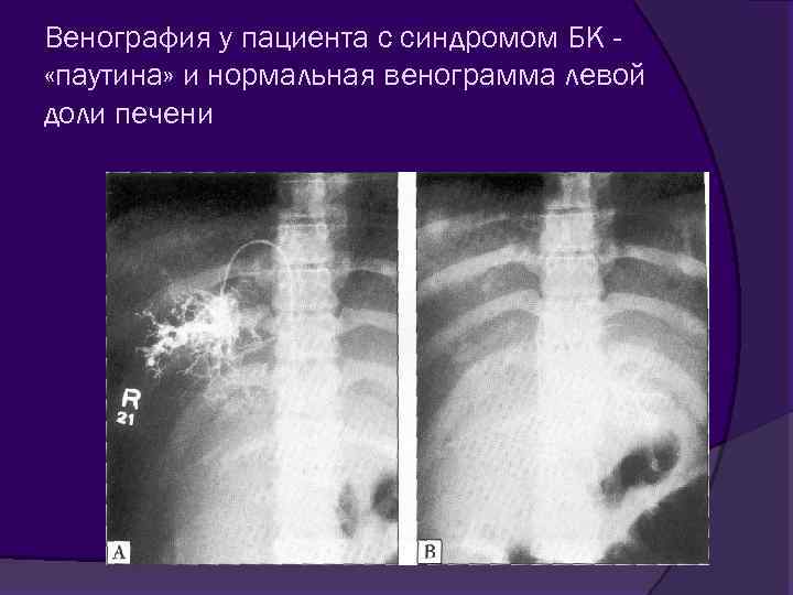 Венография у пациента с синдромом БК «паутина» и нормальная венограмма левой доли печени 