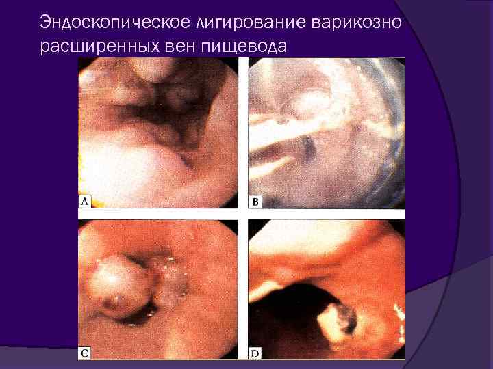 Эндоскопическое лигирование варикозно расширенных вен пищевода 