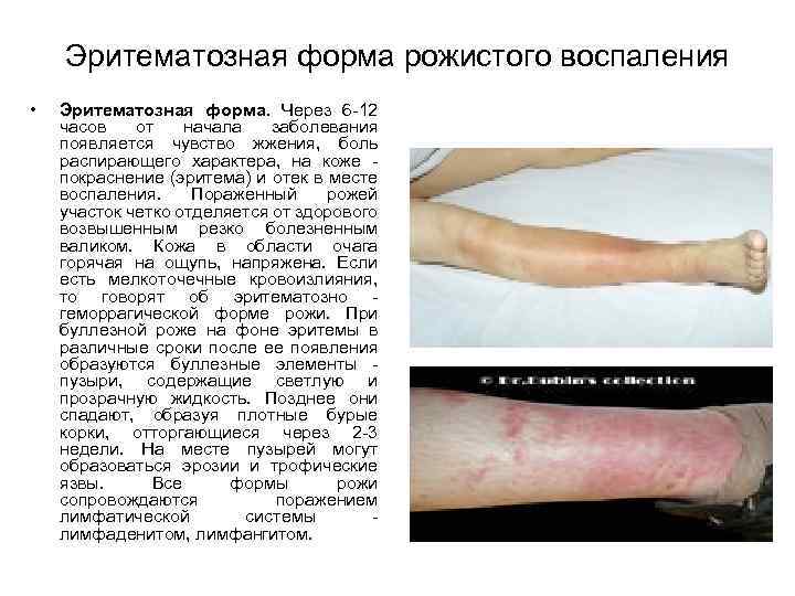 Эритематозная форма рожистого воспаления • Эритематозная форма. Через 6 12 часов от начала заболевания