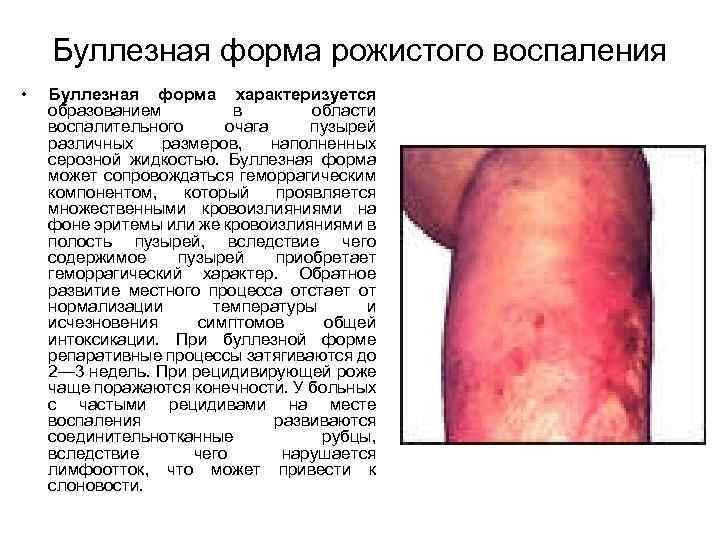Буллезная форма рожистого воспаления • Буллезная форма характеризуется образованием в области воспалительного очага пузырей