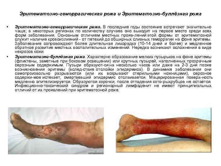Эритематозно-геморрагическая рожа и Эритематозно-буллёзная рожа • • Эритематозно-геморрагическая рожа. В последние годы состояние встречают