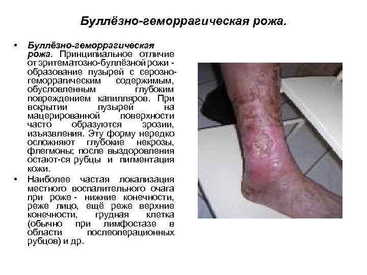 Буллёзно-геморрагическая рожа. • • Буллёзно-геморрагическая рожа. Принципиальное отличие от эритематозно буллёзной рожи образование пузырей