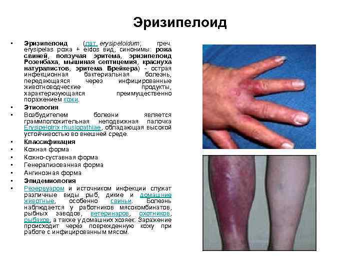 Эризипелоид • • • Эризипелоид (лат. erysipeloidum; греч. erysipelas рожа + eidos вид, синонимы: