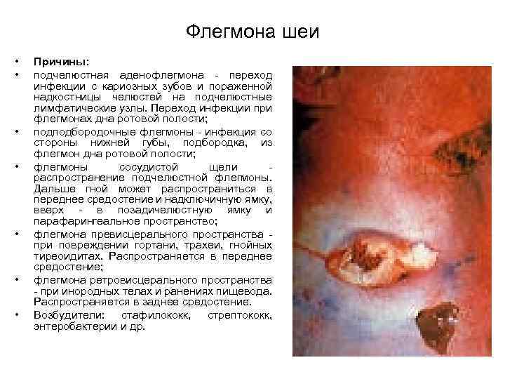 Флегмона шеи • • Причины: подчелюстная аденофлегмона переход инфекции с кариозных зубов и пораженной
