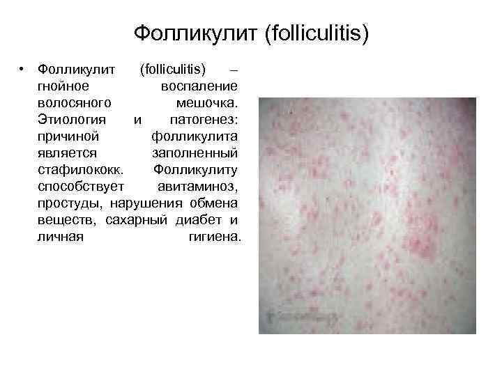 Фолликулит (folliculitis) • Фолликулит (folliculitis) – гнойное воспаление волосяного мешочка. Этиология и патогенез: причиной