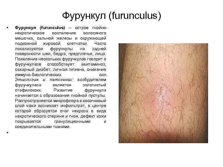 Фурункул (furunculus) • • Фурункул (furunculus) – острое гнойно некротическое воспаление волосяного мешочка, сальной