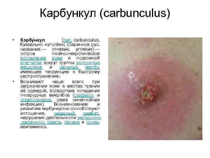 Карбункул (carbunculus) • • Карбу нкул (лат. carbunculus, буквально «уголёк» ; старинное рус. название
