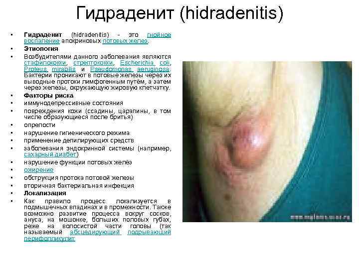 Гидраденит (hidradenitis) • • • • Гидраденит (hidradenitis) это гнойное воспаление апокриновых потовых желез.