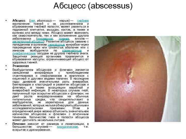 Абсцесс (abscessus) • • Абсцесс (лат. abscessus — нарыв) — гнойное воспаление тканей с
