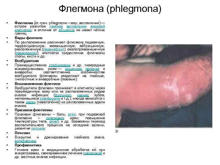 Флегмона (phlegmona) • • • • Флегмона (от греч. phlegmone – жар, воспаление) —