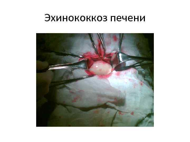 Эхинококкоз печени 