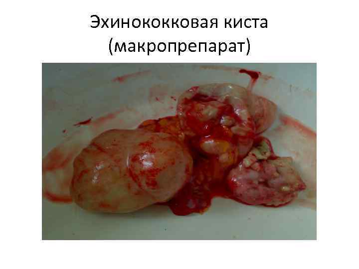 Эхинококковая киста (макропрепарат) 