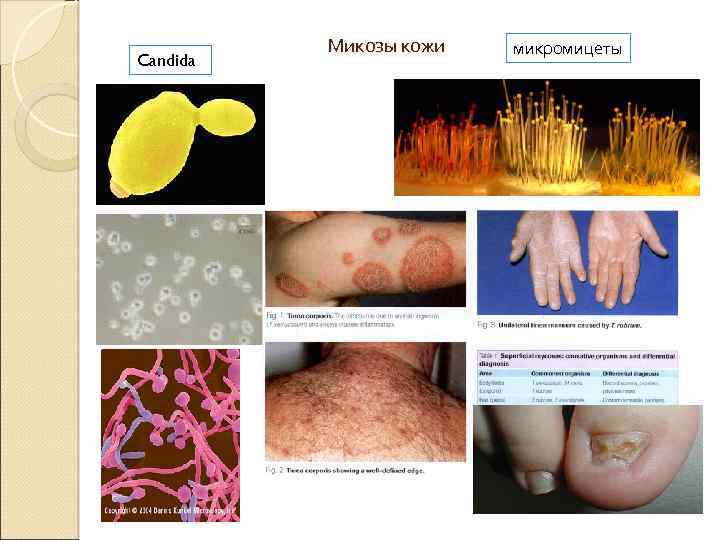 Candida Микозы кожи микромицеты 