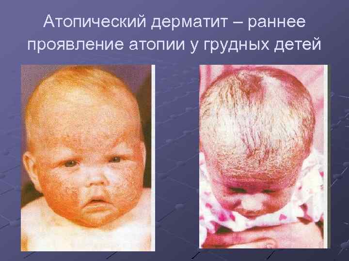Атопический дерматит – раннее проявление атопии у грудных детей 