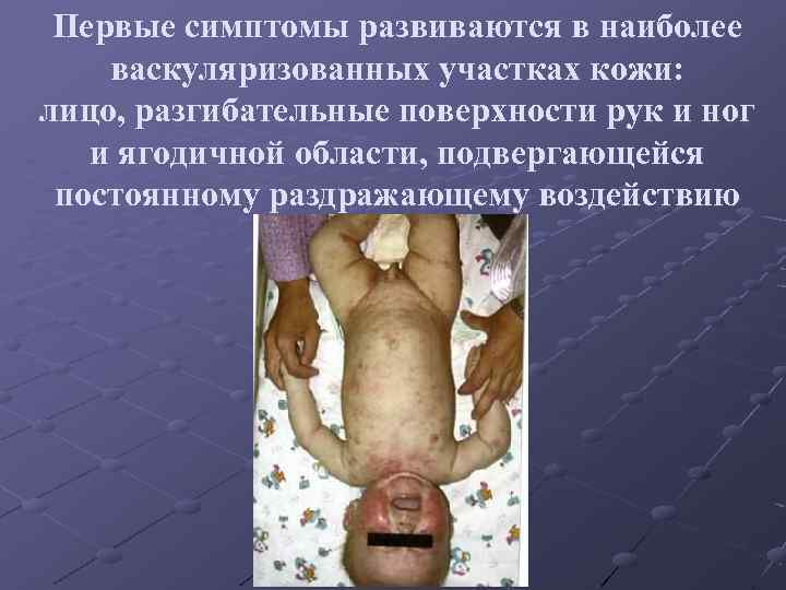 Первые симптомы развиваются в наиболее васкуляризованных участках кожи: лицо, разгибательные поверхности рук и ног