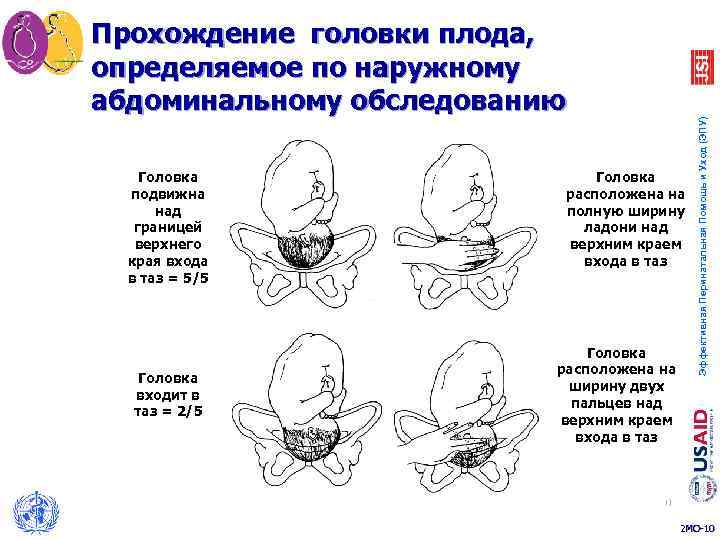 Головка подвижна над границей верхнего края входа в таз = 5/5 Головка входит в