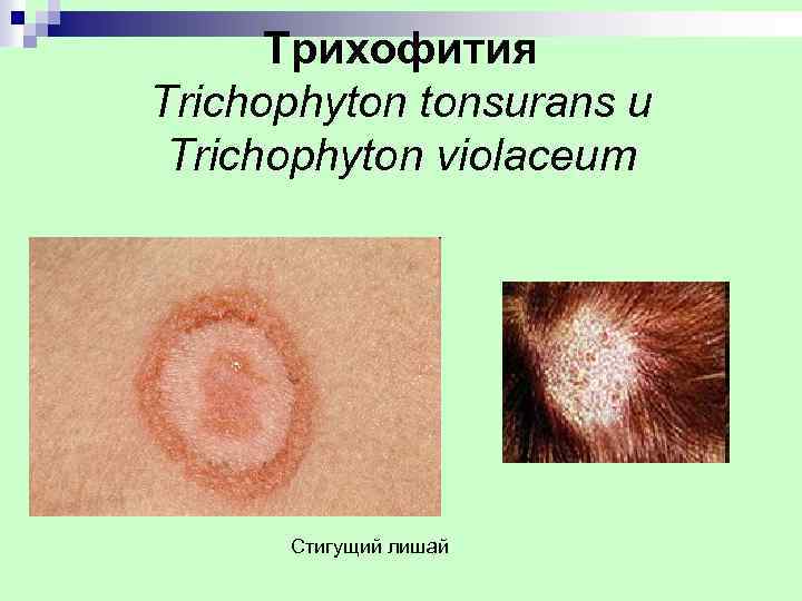 Трихофития Trichophyton tonsurans и Trichophyton violaceum Стигущий лишай 