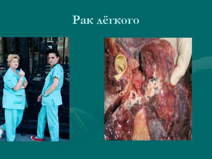 Рак лёгкого 