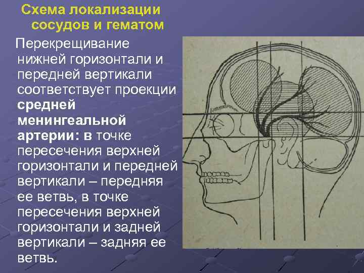 Схема локализации сосудов и гематом Перекрещивание нижней горизонтали и передней вертикали соответствует проекции средней