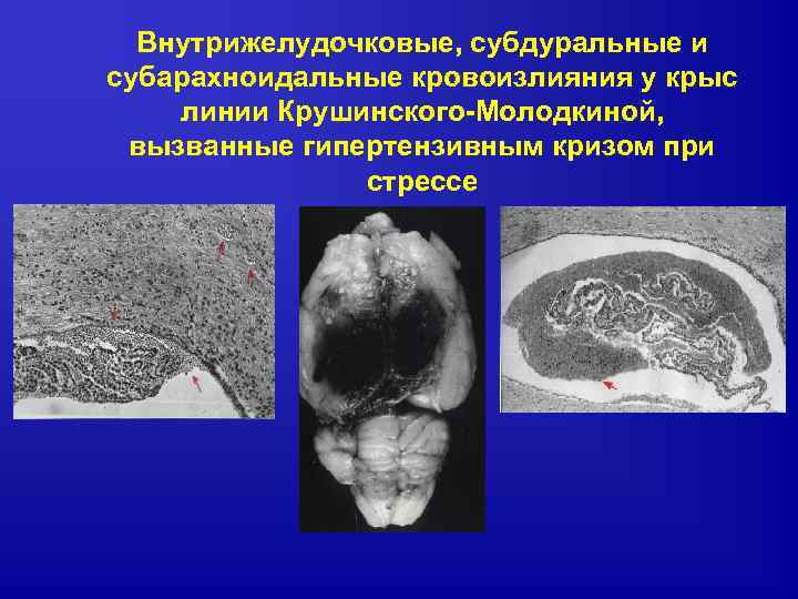 Внутрижелудочковые, субдуральные и субарахноидальные кровоизлияния у крыс линии Крушинского-Молодкиной, вызванные гипертензивным кризом при стрессе