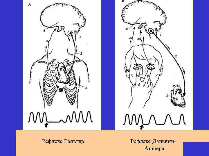 Глазосердечный рефлекс физиология схема