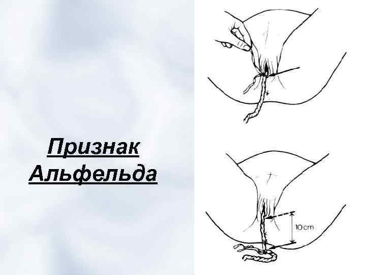 Признаки отделения плаценты