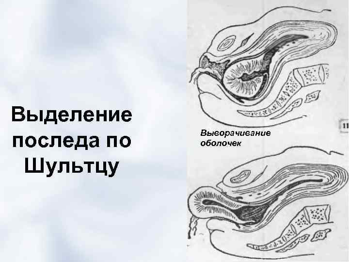 Выделение последа по Шультцу Выворачивание оболочек 