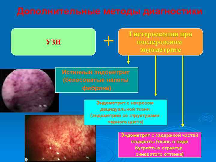 Дополнительные методы диагностики Гистероскопия при УЗИ + послеродовом эндометрите Истинный эндометрит (белесоватые налеты фибрина)