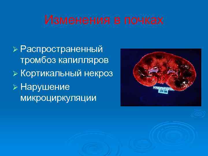  Изменения в почках Ø Распространенный тромбоз капилляров Ø Кортикальный некроз Ø Нарушение микроциркуляции