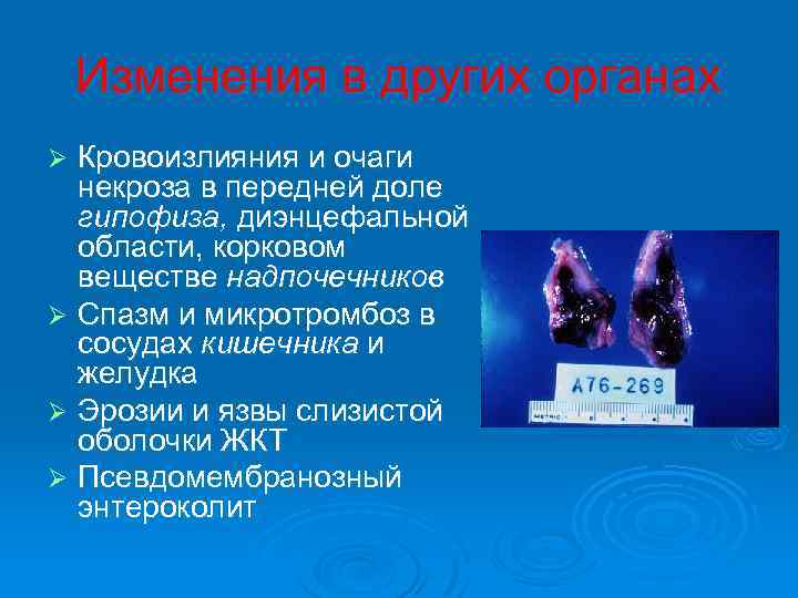  Изменения в других органах Ø Кровоизлияния и очаги некроза в передней доле гипофиза,