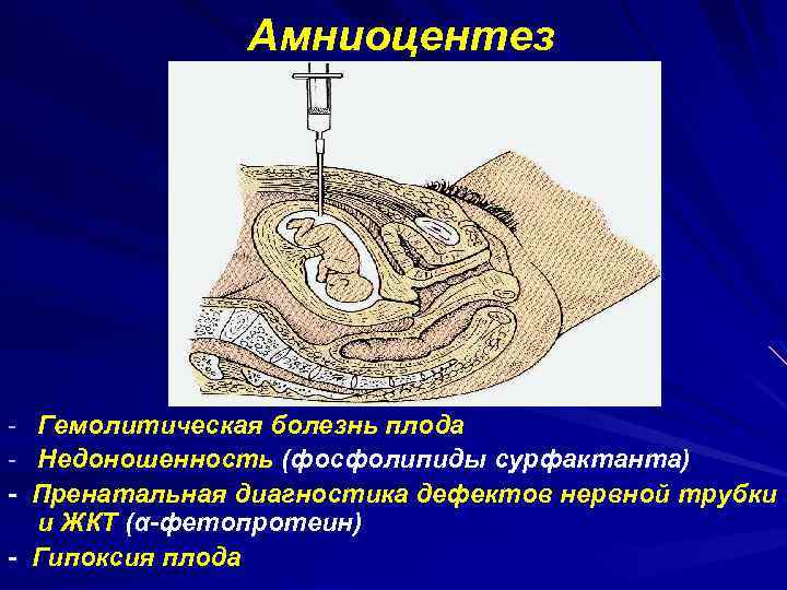 Амниоцентез - Гемолитическая болезнь плода - Недоношенность (фосфолипиды сурфактанта) - Пренатальная диагностика дефектов нервной