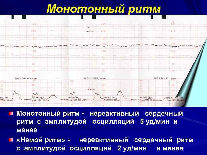 Монотонный ритм - нереактивный сердечный ритм с амплитудой осцилляций 5 уд/мин и менее «Немой