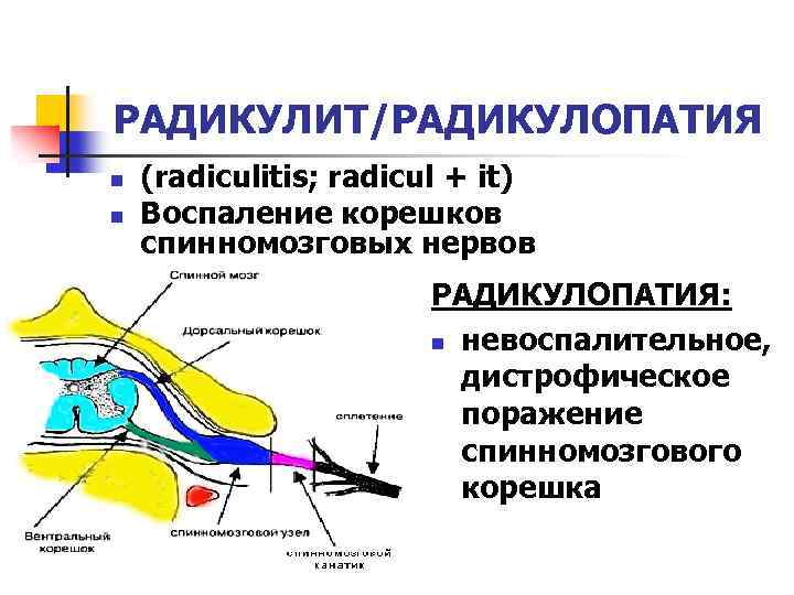 Радикулопатия что. Спондилогенная радикулопатия. Радикулопатии неврология. Шейная радикулопатия. Воспаление нервных Корешков.