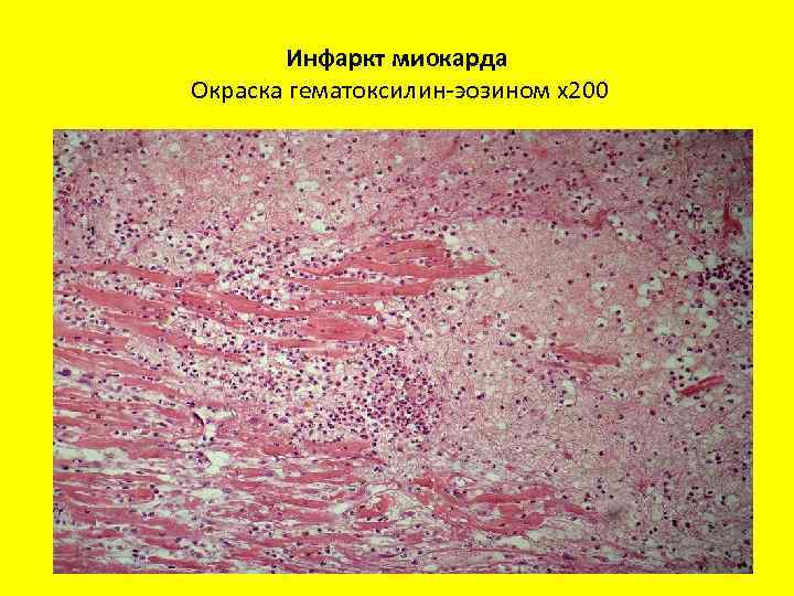 Инфаркт миокарда Окраска гематоксилин-эозином х200 