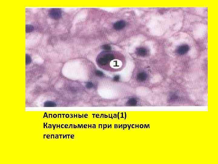 Апоптотические тельца Апоптозные тельца(1) Каунсельмена при вирусном гепатите 