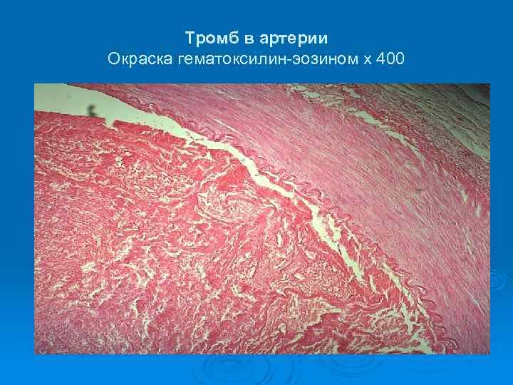 Тромб в артерии Окраска гематоксилин-эозином х 400 
