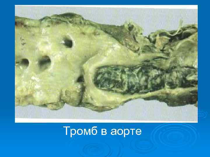 Тромб в аорте 