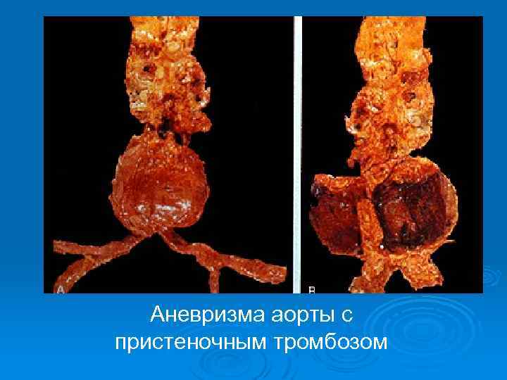 Аневризма аорты с пристеночным тромбозом 