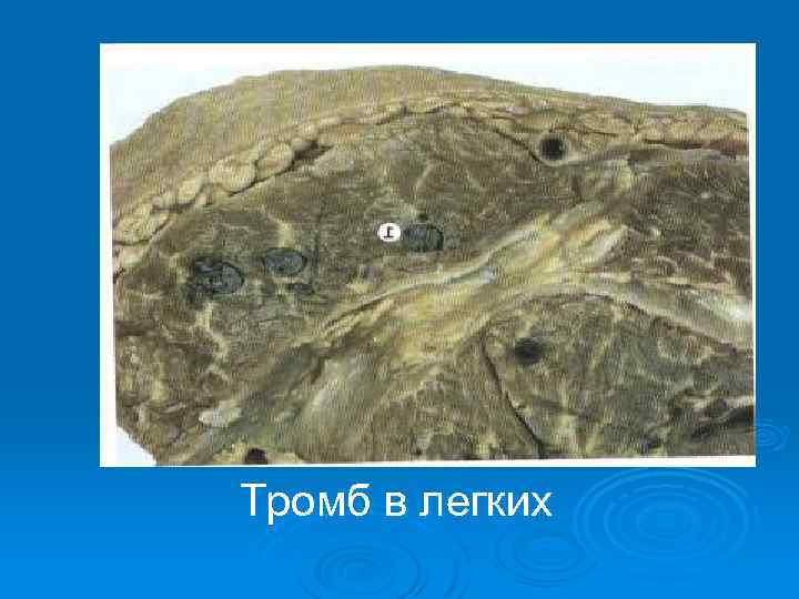 Тромб в легких 