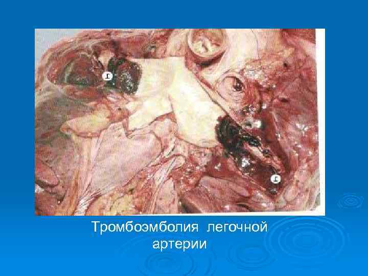 Тромбоэмболия легочной артерии 