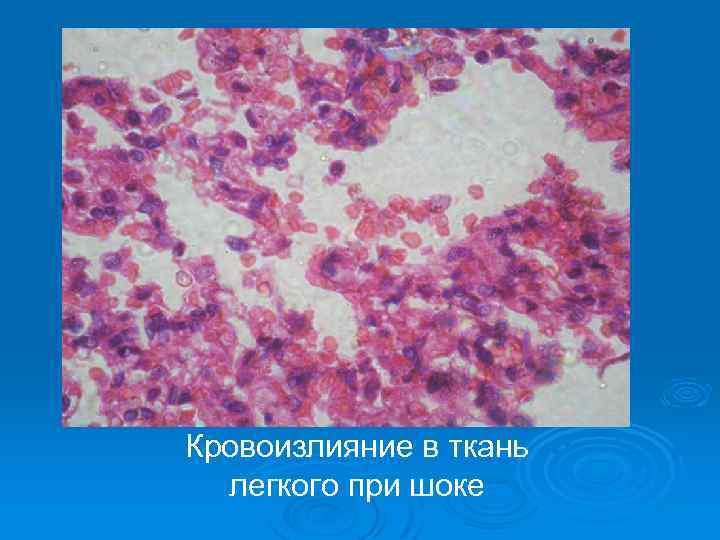 Кровоизлияние в ткань легкого при шоке 