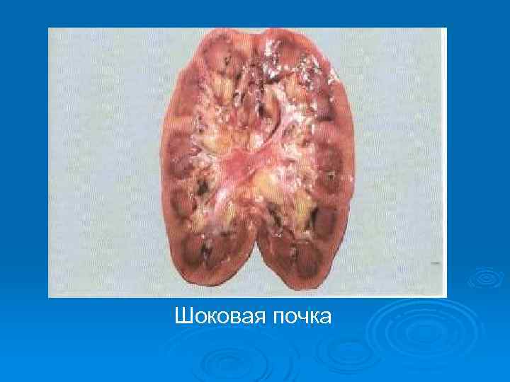 Шоковая почка 