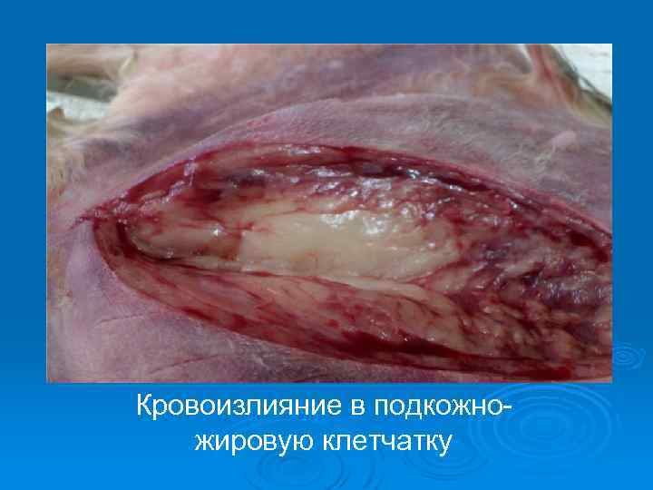 Кровоизлияние в подкожножировую клетчатку 